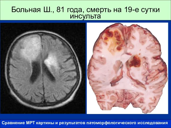 Больная Ш., 81 года, смерть на 19-е сутки инсульта Сравнение МРТ картины и результатов патоморфологического исследования