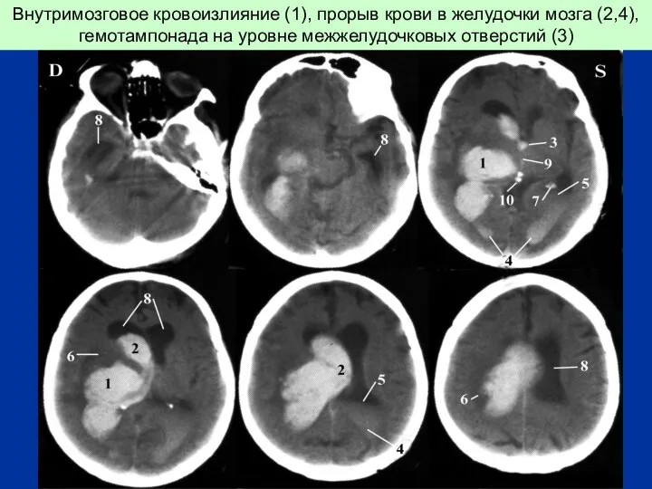 Внутримозговое кровоизлияние (1), прорыв крови в желудочки мозга (2,4), гемотампонада на уровне межжелудочковых отверстий (3)