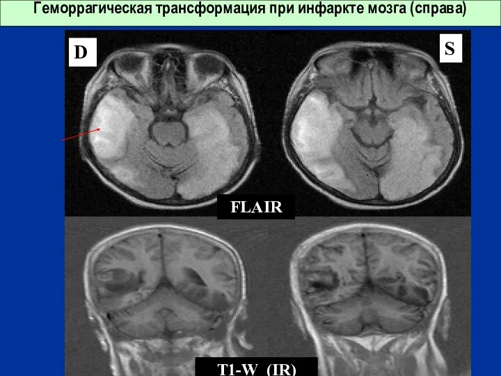 Геморрагическая трансформация при инфаркте мозга (справа) FLAIR T1-W (IR) D S