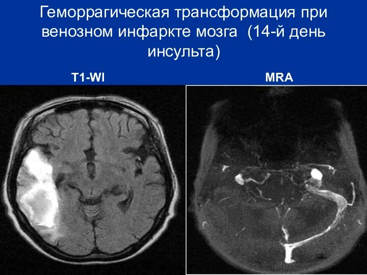 Геморрагическая трансформация при венозном инфаркте мозга (14-й день инсульта) T1-WI MRA