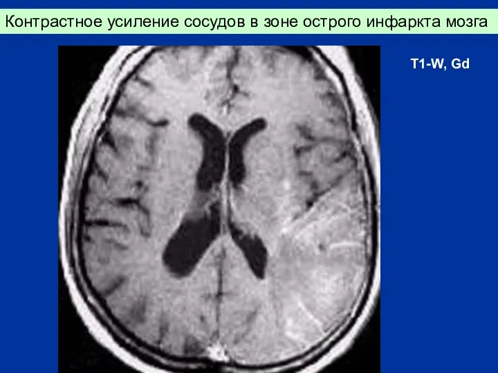 Контрастное усиление сосудов в зоне острого инфаркта мозга T1-W, Gd