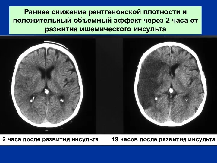 2 часа после развития инсульта 19 часов после развития инсульта Раннее