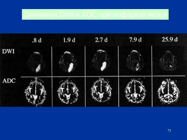 Динамика DWI и ADC при инфаркте мозга