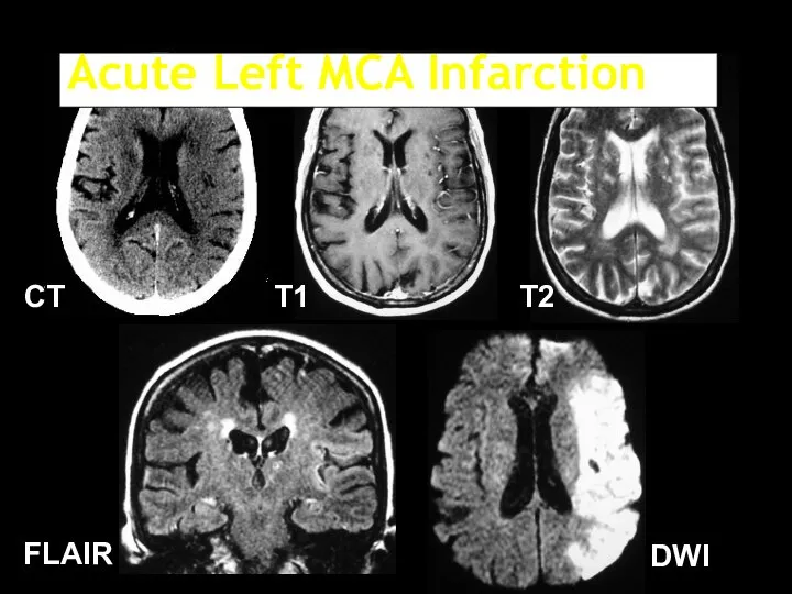 T1 T2 FLAIR DWI CT Acute Left MCA Infarction