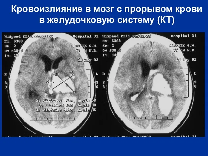 Кровоизлияние в мозг с прорывом крови в желудочковую систему (КТ)