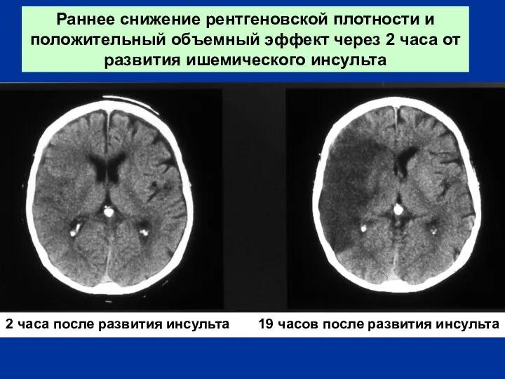 2 часа после развития инсульта 19 часов после развития инсульта Раннее