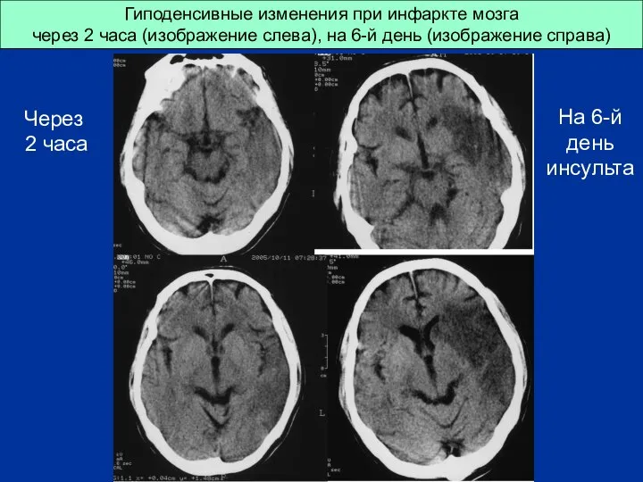 Гиподенсивные изменения при инфаркте мозга через 2 часа (изображение слева), на