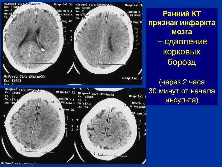 Ранний КТ признак инфаркта мозга – сдавление корковых борозд (через 2