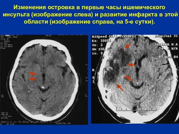 Изменения островка в первые часы ишемического инсульта (изображение слева) и развитие