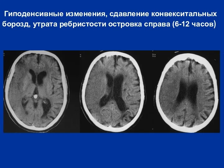 Гиподенсивные изменения, сдавление конвекситальных борозд, утрата ребристости островка справа (6-12 часов)