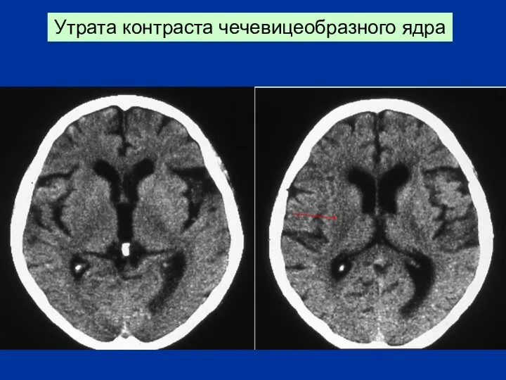 Утрата контраста чечевицеобразного ядра