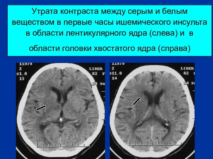 Утрата контраста между серым и белым веществом в первые часы ишемического