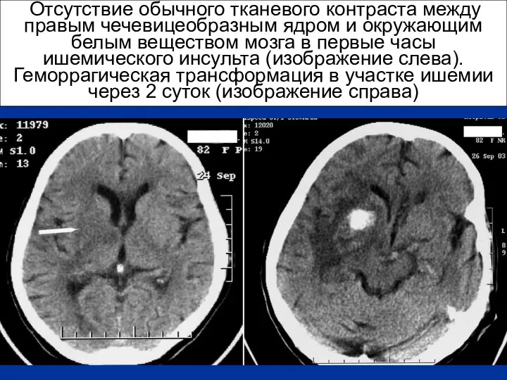 Отсутствие обычного тканевого контраста между правым чечевицеобразным ядром и окружающим белым