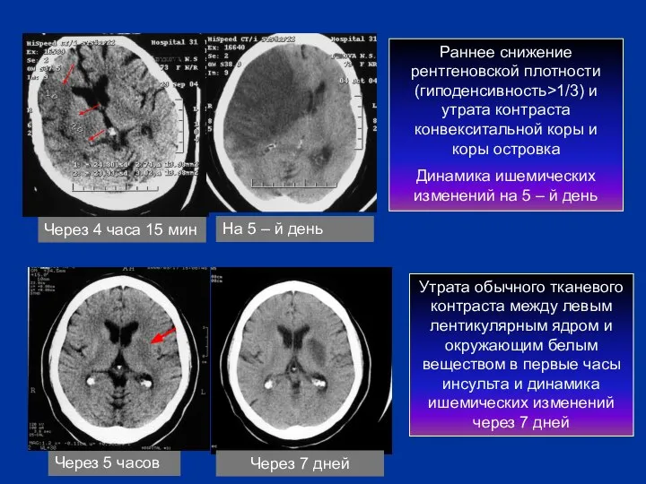 Через 4 часа 15 мин Раннее снижение рентгеновской плотности (гиподенсивность>1/3) и