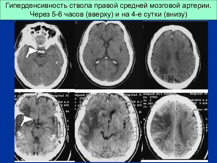 Гиперденсивность ствола правой средней мозговой артерии. Через 5-6 часов (вверху) и на 4-е сутки (внизу)