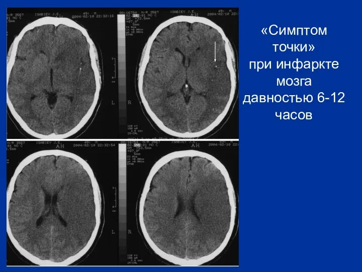 «Симптом точки» при инфаркте мозга давностью 6-12 часов