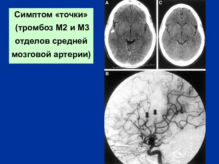 Симптом «точки» (тромбоз М2 и М3 отделов средней мозговой артерии)