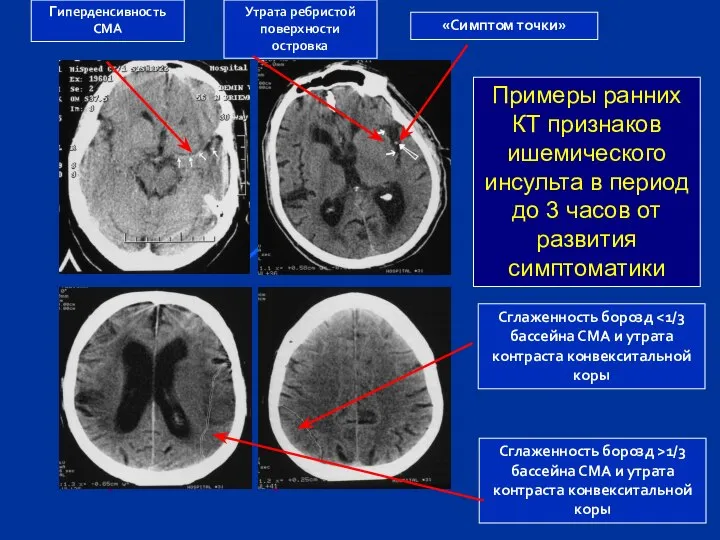 Гиперденсивность СМА «Симптом точки» Сглаженность борозд >1/3 бассейна СМА и утрата