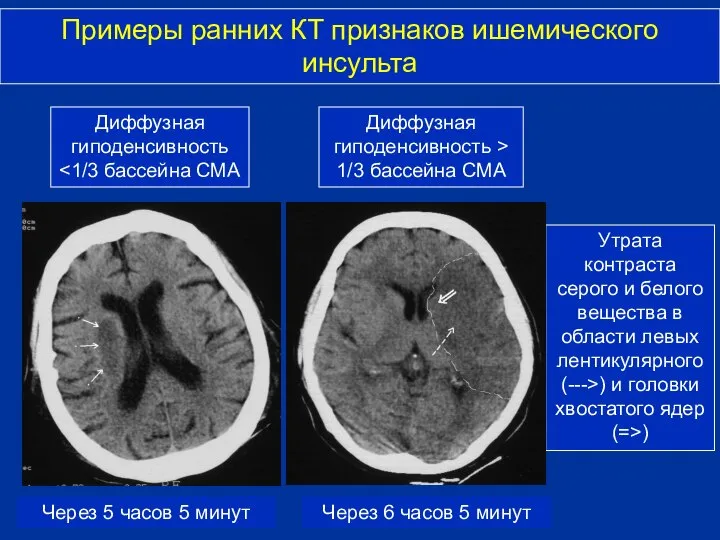 Через 5 часов 5 минут Примеры ранних КТ признаков ишемического инсульта