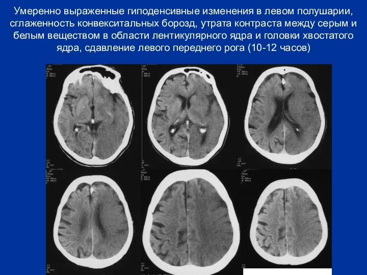 Умеренно выраженные гиподенсивные изменения в левом полушарии, сглаженность конвекситальных борозд, утрата