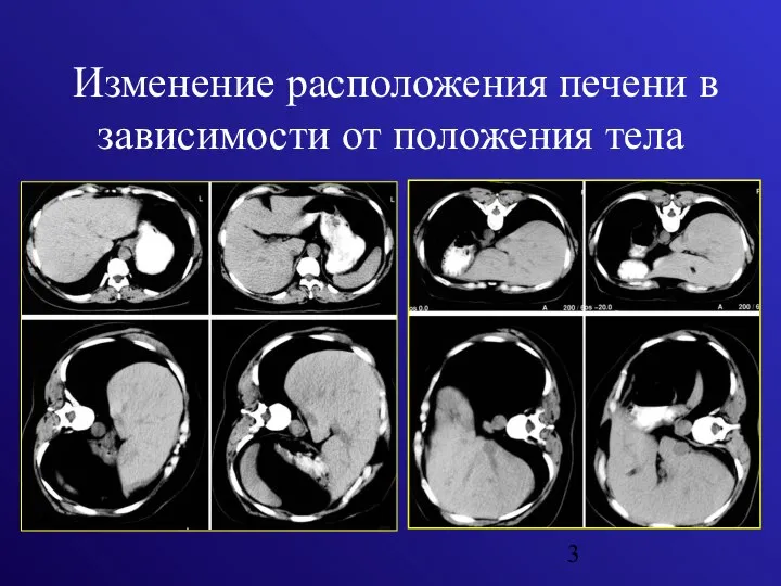 Изменение расположения печени в зависимости от положения тела