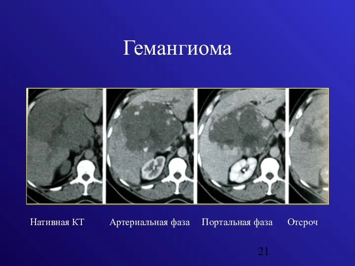 Гемангиома Нативная КТ Артериальная фаза Портальная фаза Отсроч