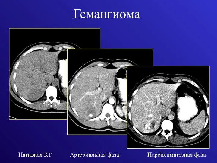 Гемангиома Нативная КТ Артериальная фаза Паренхиматозная фаза