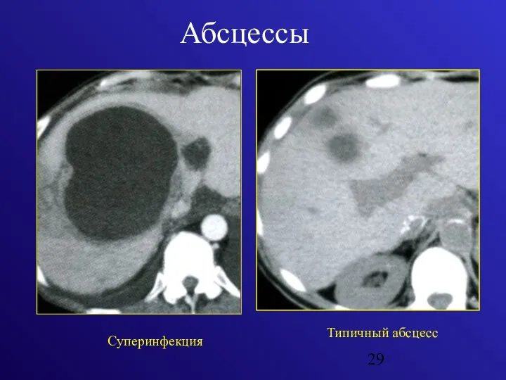 Абсцессы Суперинфекция Типичный абсцесс