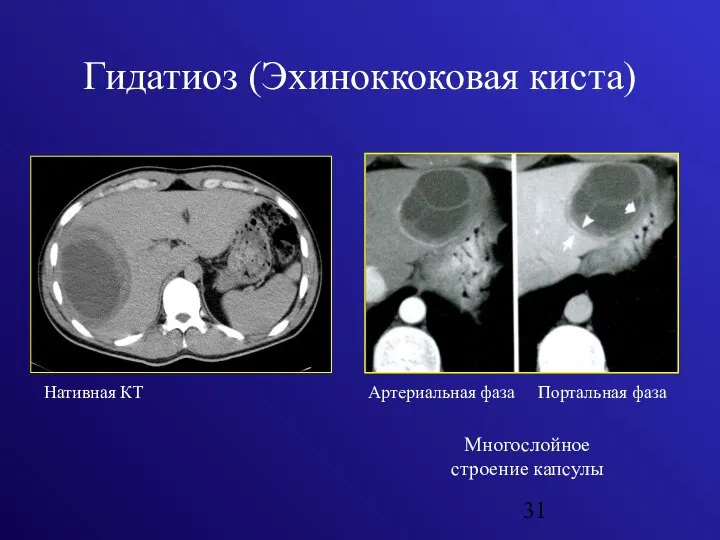 Гидатиоз (Эхиноккоковая киста) Нативная КТ Артериальная фаза Портальная фаза Многослойное строение капсулы