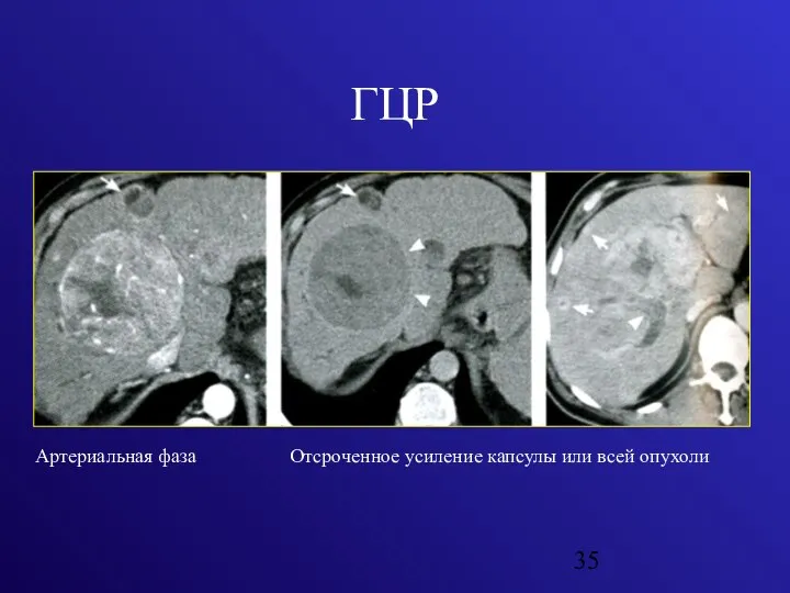ГЦР Артериальная фаза Отсроченное усиление капсулы или всей опухоли