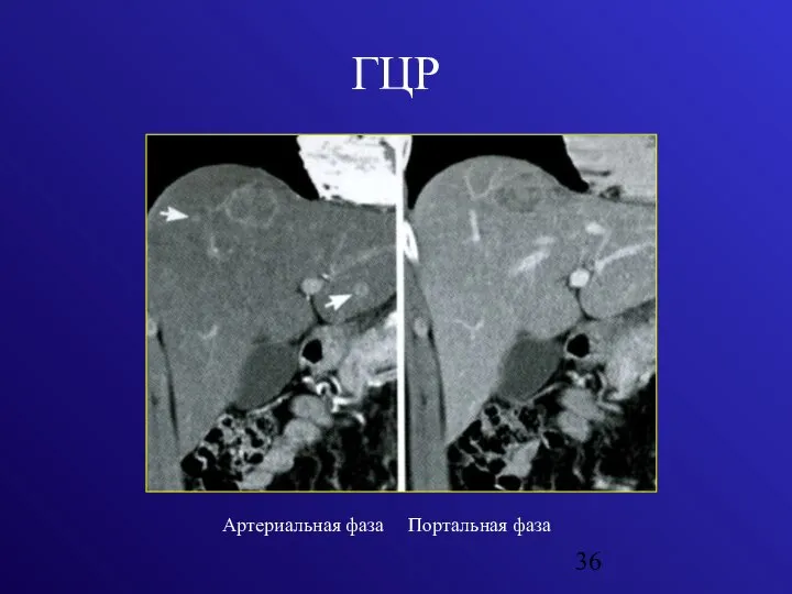 ГЦР Артериальная фаза Портальная фаза