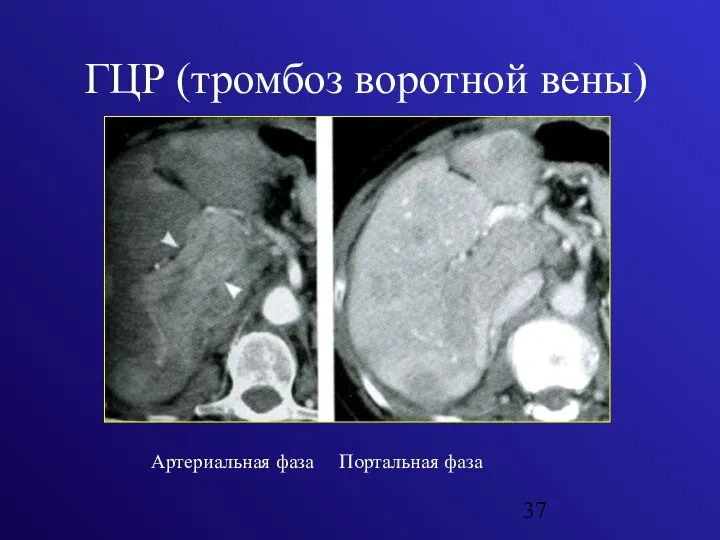 ГЦР (тромбоз воротной вены) Артериальная фаза Портальная фаза