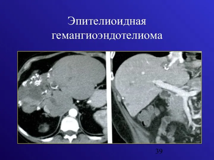 Эпителиоидная гемангиоэндотелиома