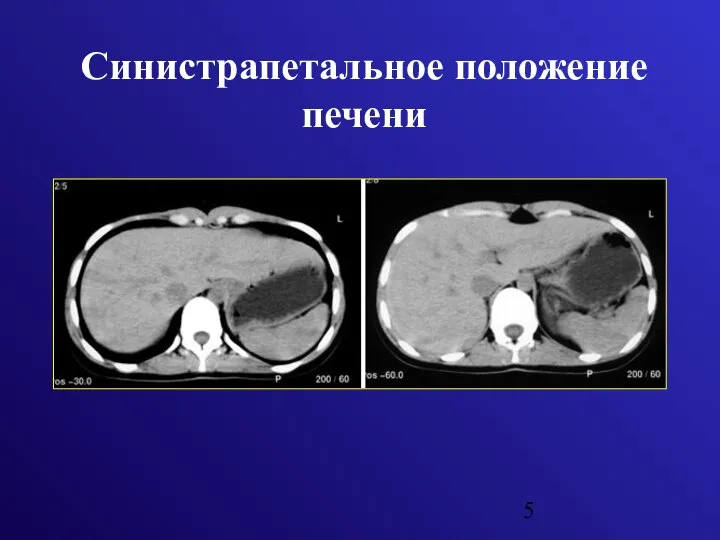 Синистрапетальное положение печени