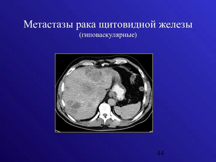 Метастазы рака щитовидной железы (гиповаскулярные)
