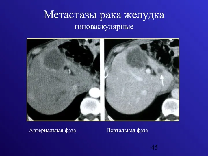 Метастазы рака желудка гиповаскулярные Артериальная фаза Портальная фаза