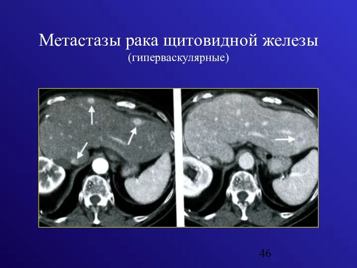Метастазы рака щитовидной железы (гиперваскулярные)