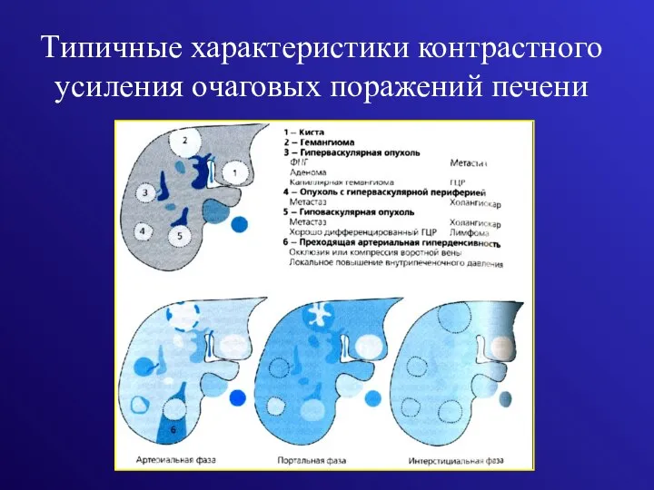 Типичные характеристики контрастного усиления очаговых поражений печени