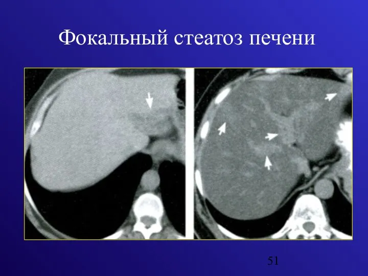 Фокальный стеатоз печени