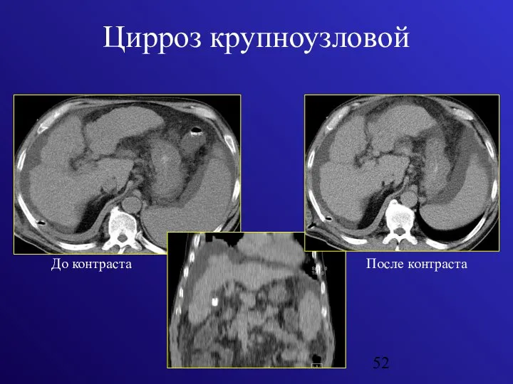 Цирроз крупноузловой До контраста После контраста