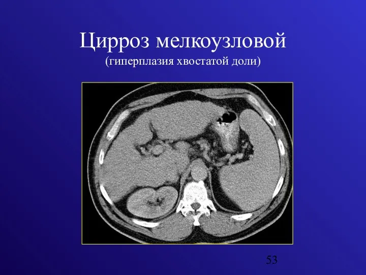 Цирроз мелкоузловой (гиперплазия хвостатой доли)