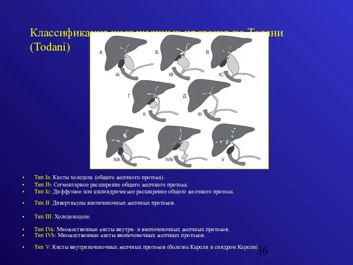 Классификация кист желчных протоков по Тодани (Todani) Тип Iа: Кисты холедоха