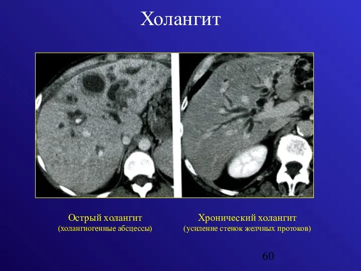 Холангит Острый холангит (холангиогенные абсцессы) Хронический холангит (усиление стенок желчных протоков)