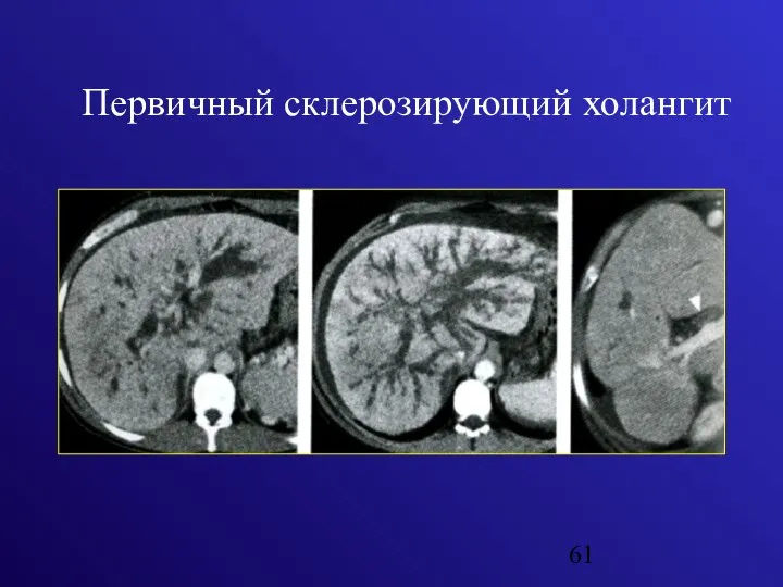 Первичный склерозирующий холангит