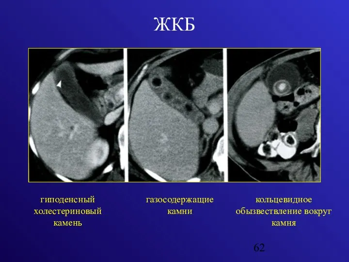 ЖКБ гиподенсный холестериновый камень газосодержащие камни кольцевидное обызвествление вокруг камня