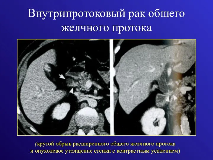 Внутрипротоковый рак общего желчного протока (крутой обрыв расширенного общего желчного протока