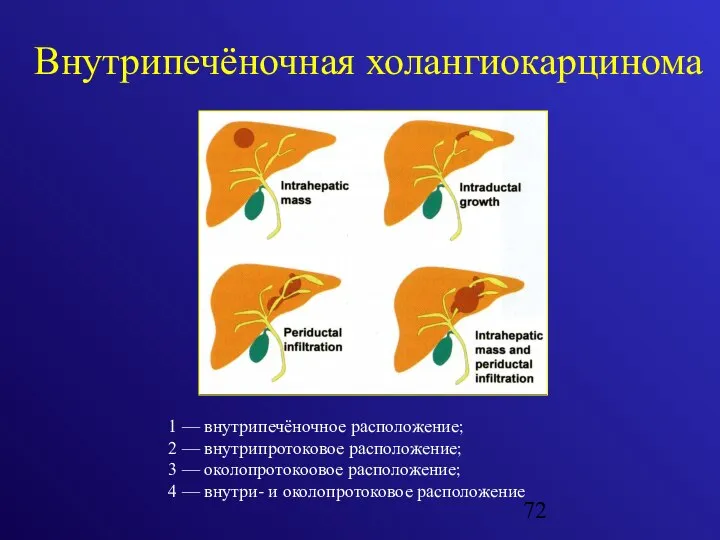 Внутрипечёночная холангиокарцинома 1 — внутрипечёночное расположение; 2 — внутрипротоковое расположение; 3