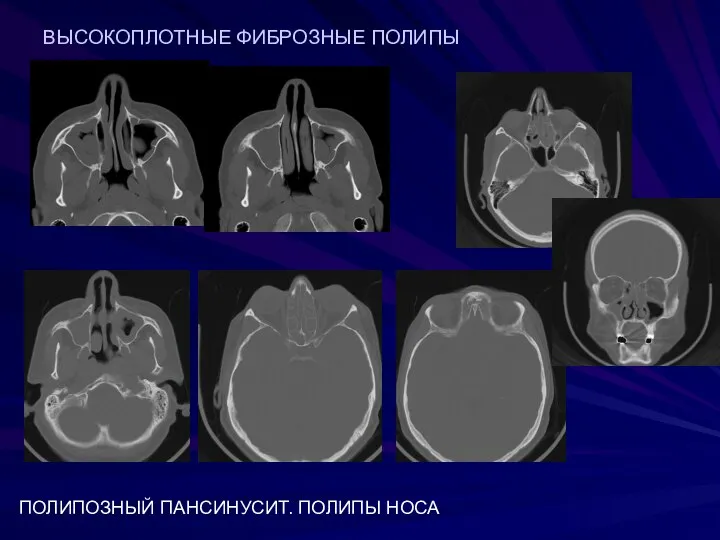 ВЫСОКОПЛОТНЫЕ ФИБРОЗНЫЕ ПОЛИПЫ ПОЛИПОЗНЫЙ ПАНСИНУСИТ. ПОЛИПЫ НОСА