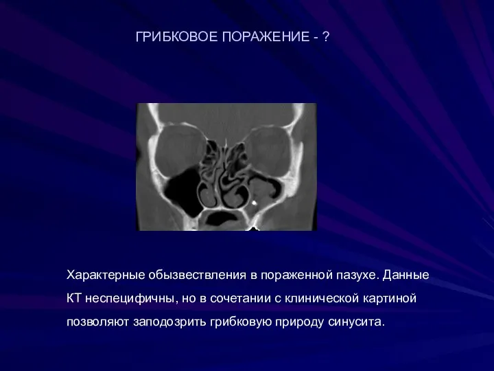 Характерные обызвествления в пораженной пазухе. Данные КТ неспецифичны, но в сочетании