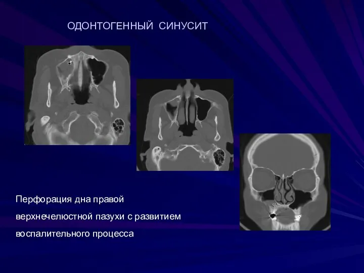 Перфорация дна правой верхнечелюстной пазухи с развитием воспалительного процесса ОДОНТОГЕННЫЙ СИНУСИТ